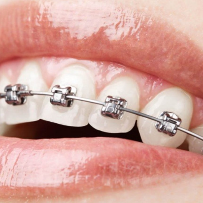 braces treatment in chennai