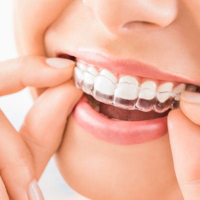 Invisalign treatment in Chennai