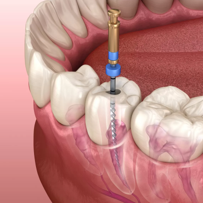 root canal treatment