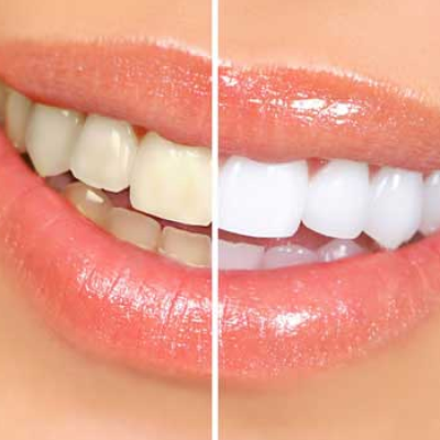 best teeth whiting treatment in Chennai